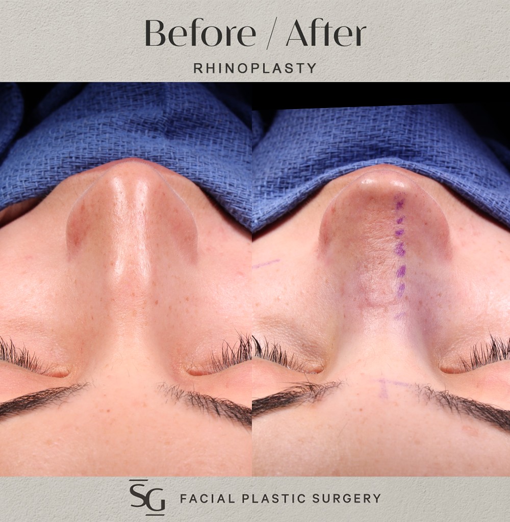 AG-frontal-intraop