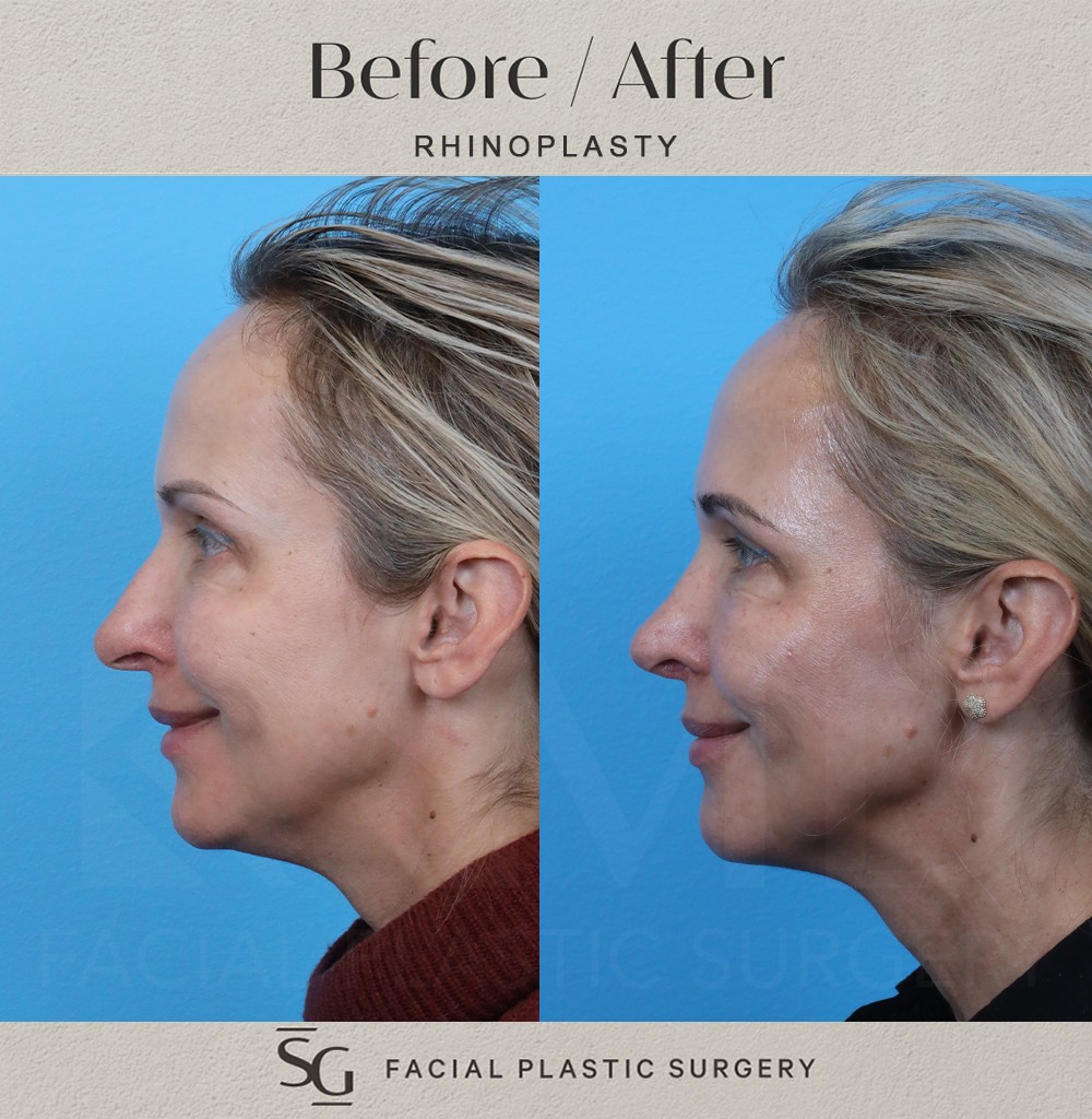 AS-6-month-profile-1-smile