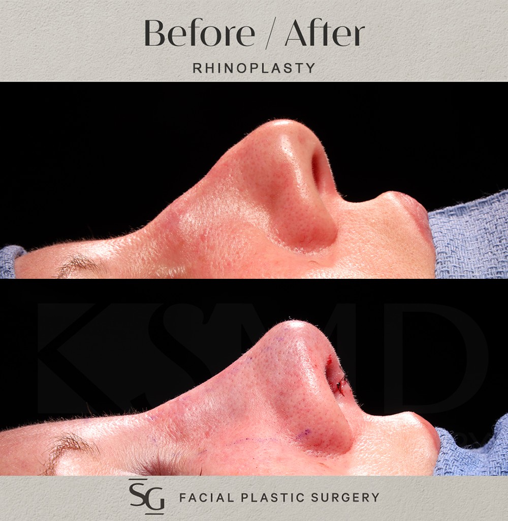 HH-profile-1-intraop-rhinoplasty