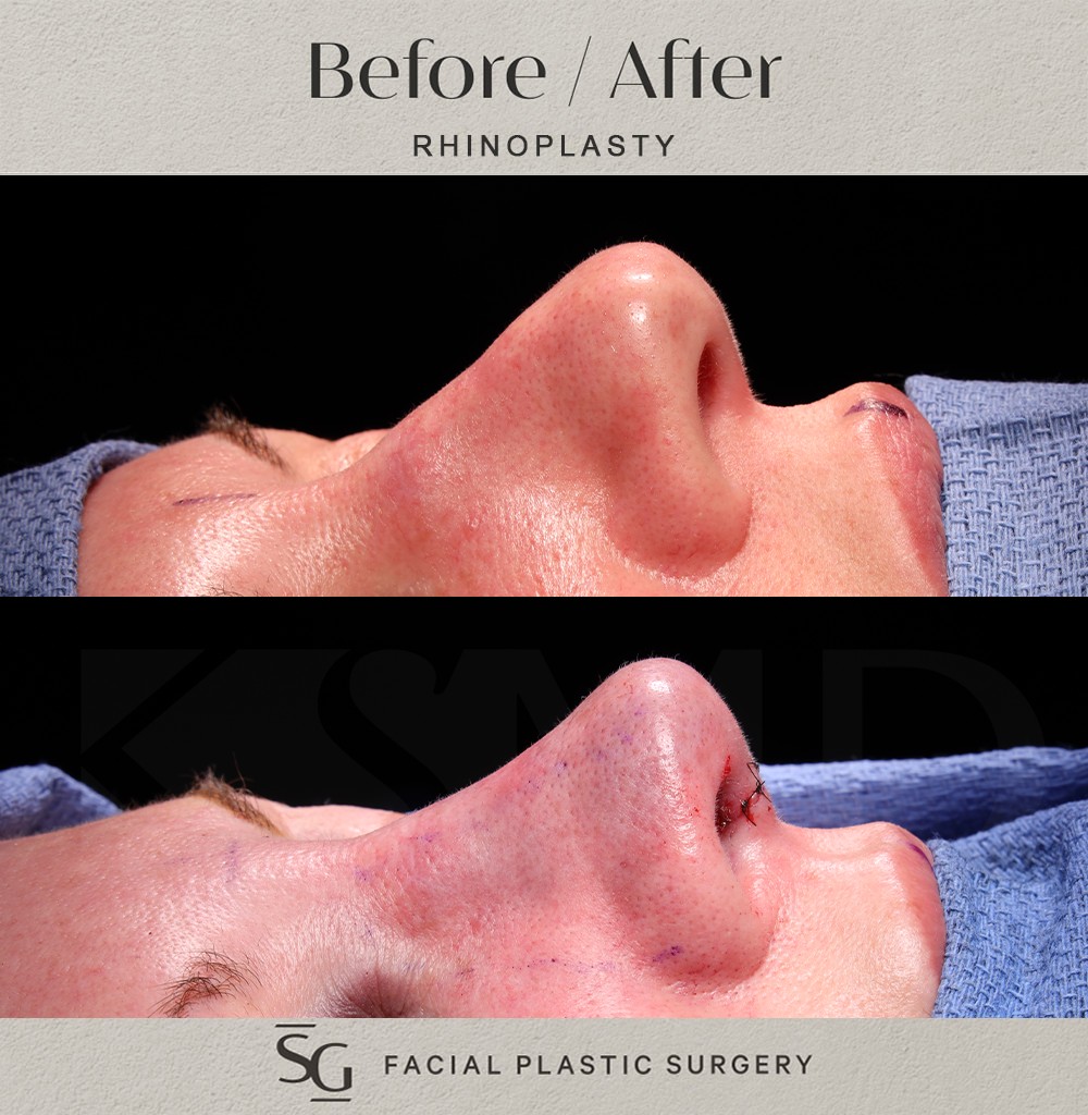 HH-oblique-1-intraop-rhinoplasty