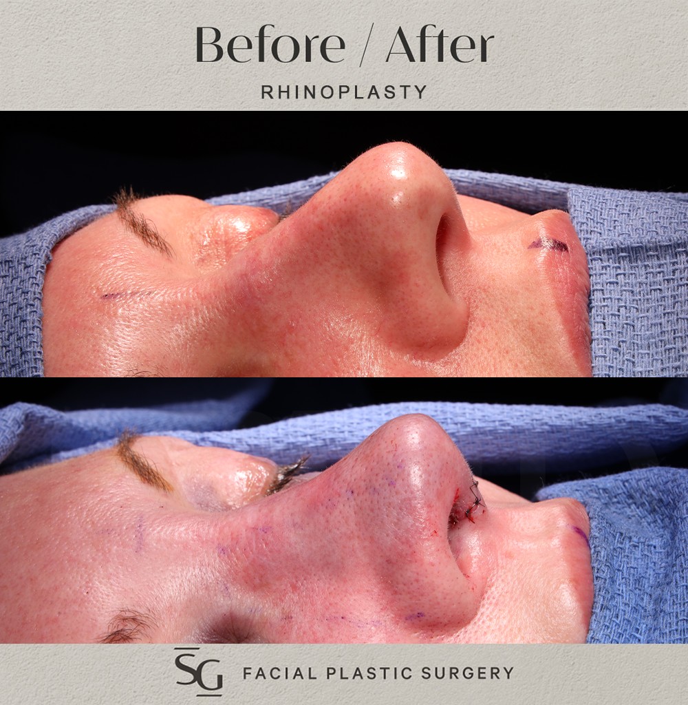 HH-Oblique-2-intraop-rhinoplasty