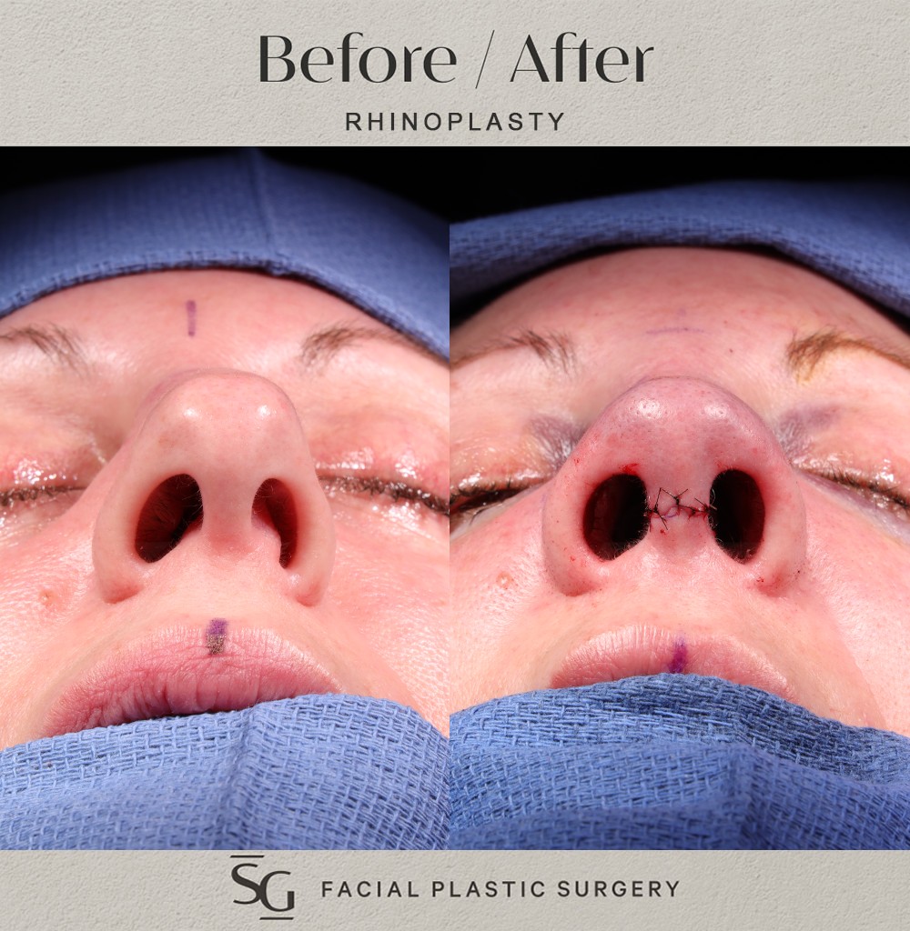 HH-basal-intraop-rhinoplasty