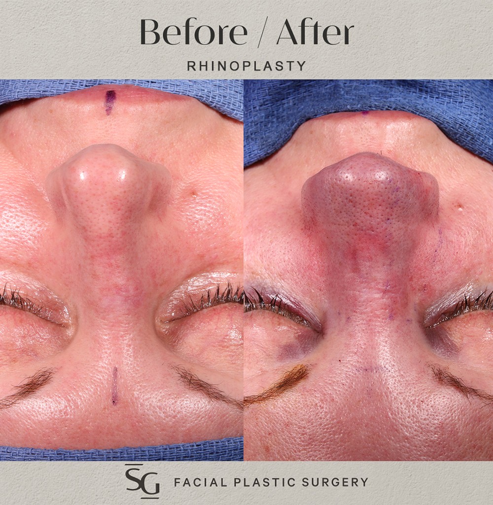 HH-frontal-intraop-rhinoplasty