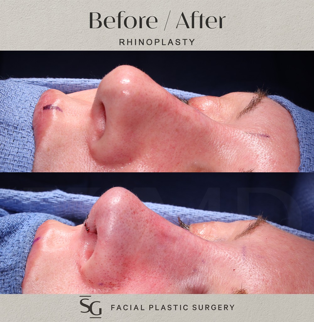 HH-Oblique-3-intraop-rhinoplasty