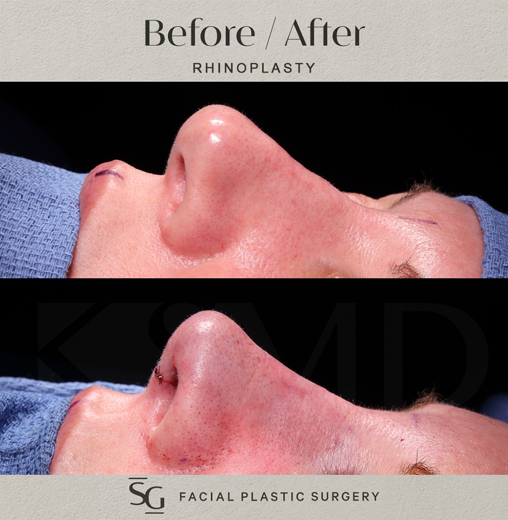 HH-oblique-4-intraop-rhinoplasty