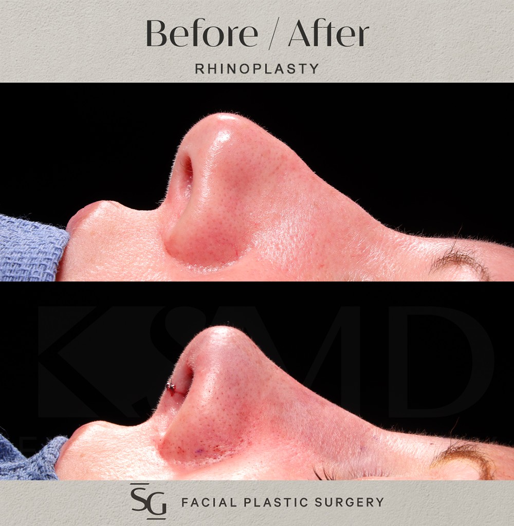 HH-Profile-2-intraop-rhinoplasty