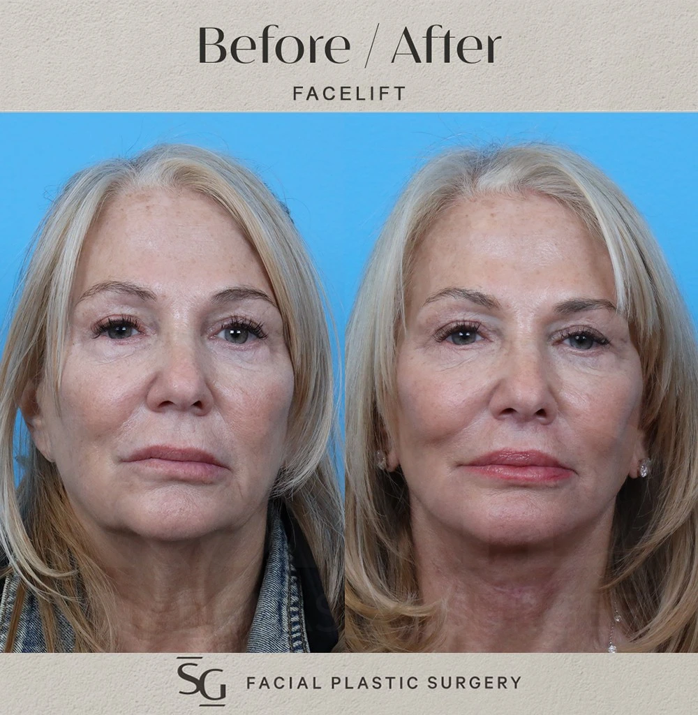 KR frontal