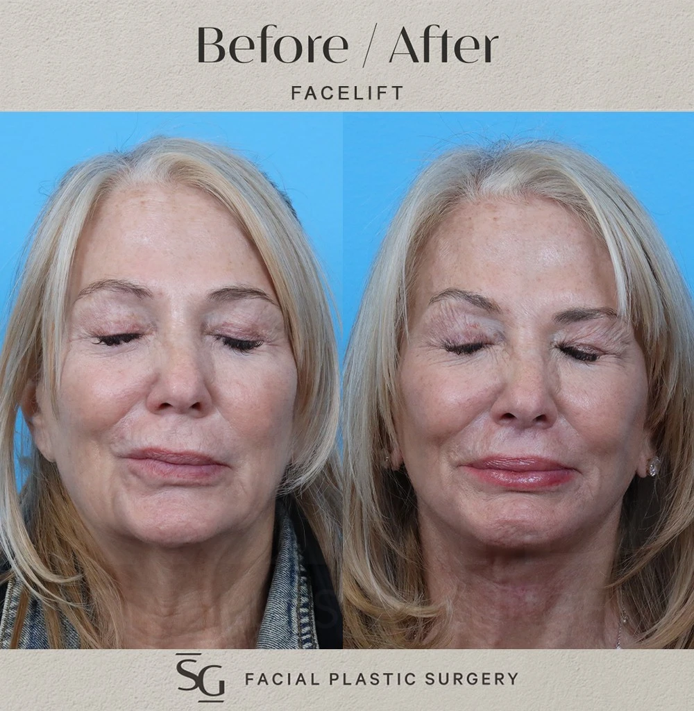 KR frontal eye closure
