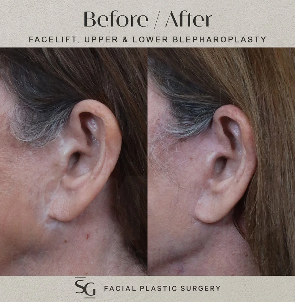 JW facelift scars