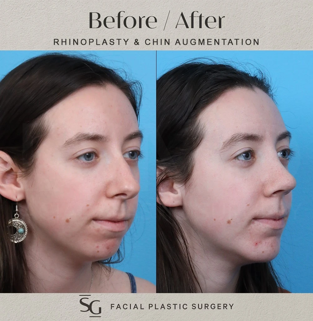 MG 3 month oblique