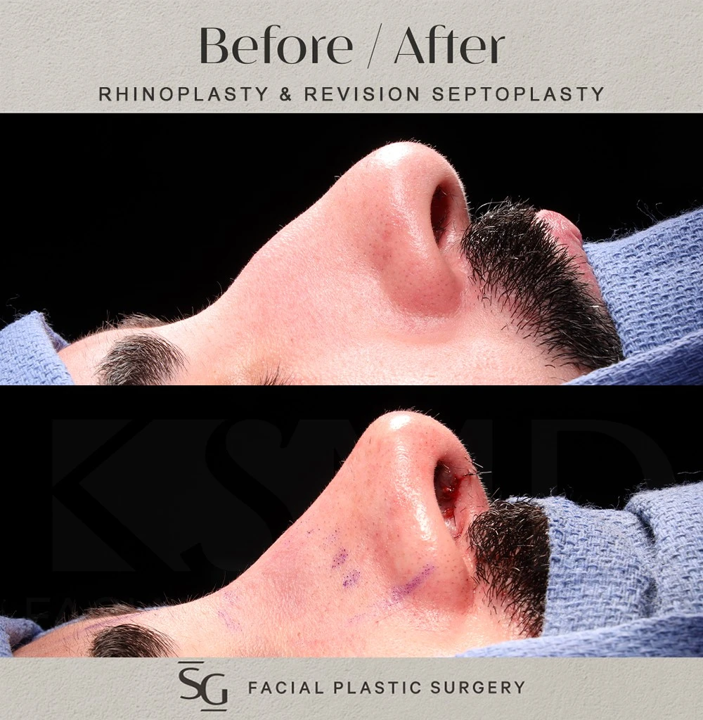 SO intraop profile 1
