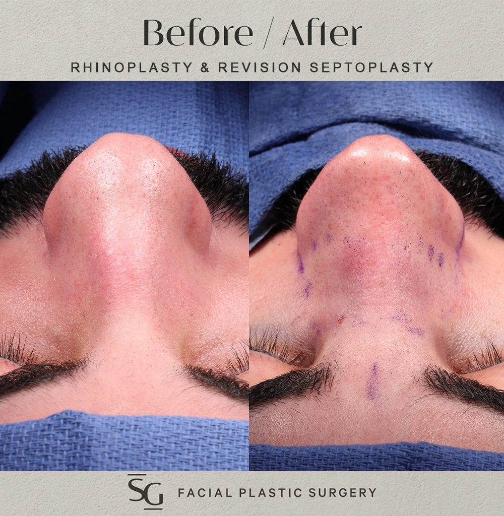 SO intraop frontal