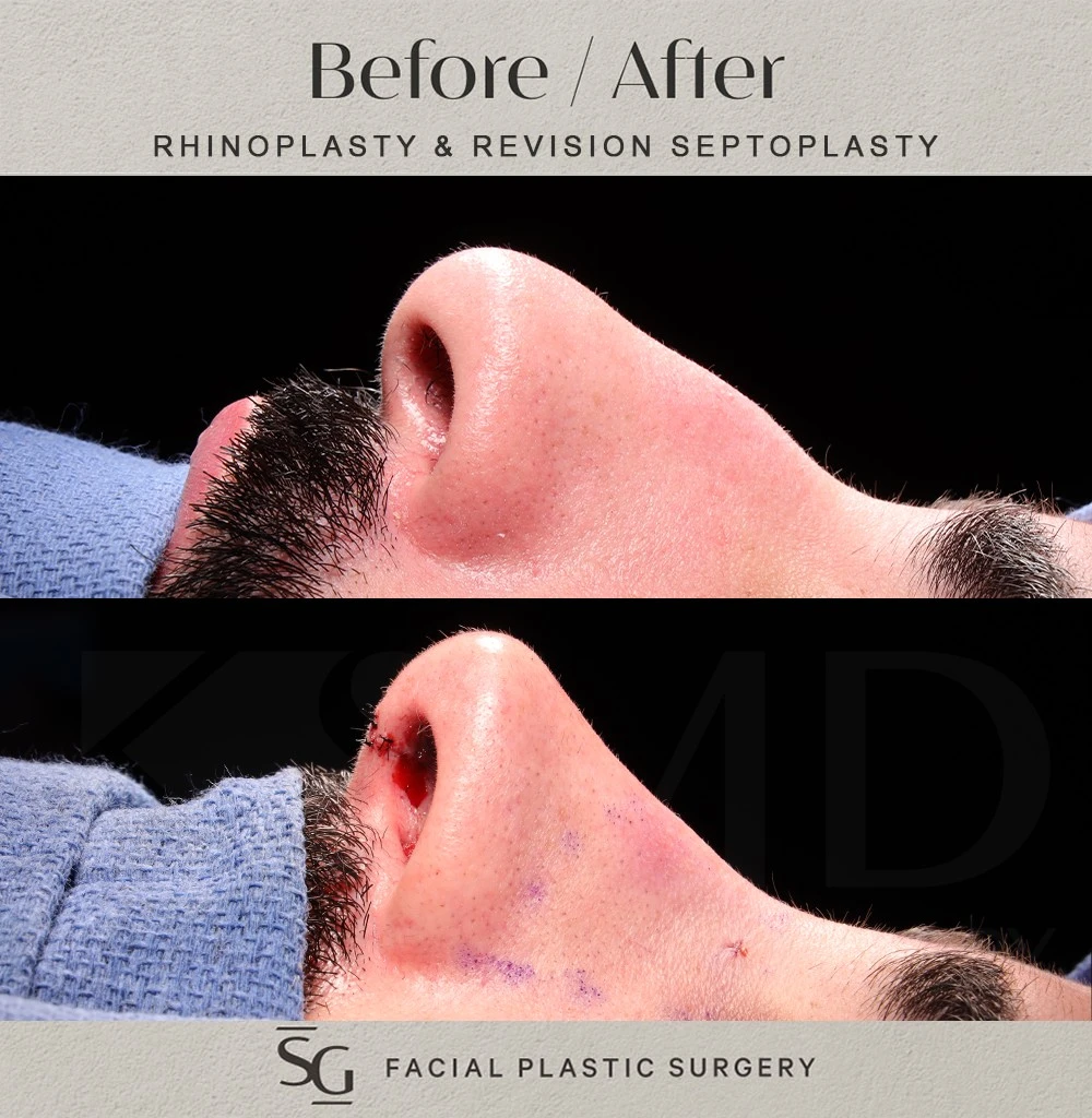 SO intraop profile 2