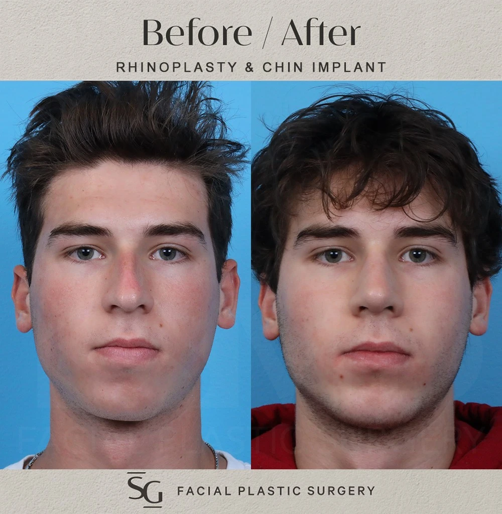 SS frontal 2 month
