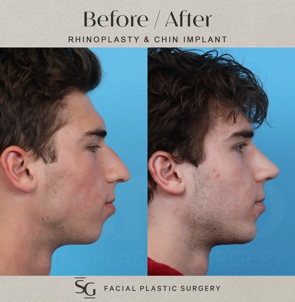 SS profile 2 month