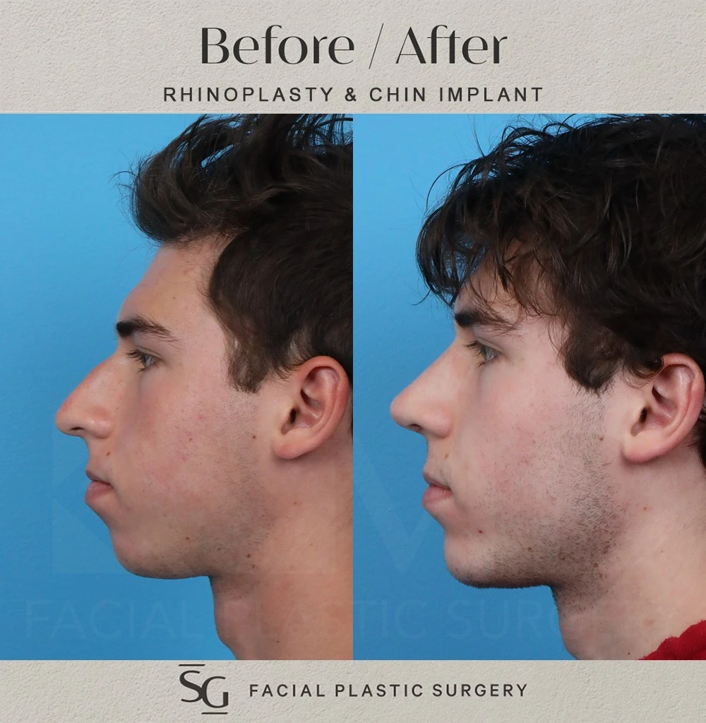 SS profile 2 month