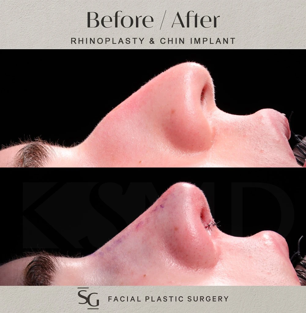 SS profile 1 intraop