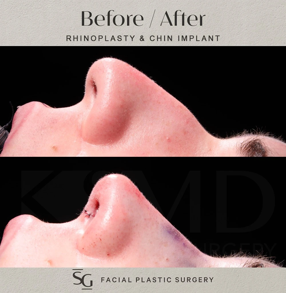 SS profile 2 intraop