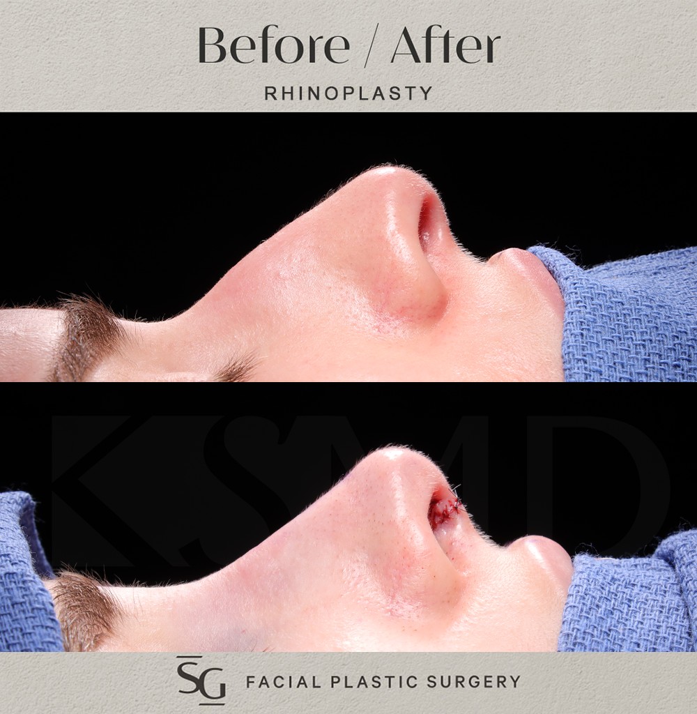 JP-profile-1-intraop