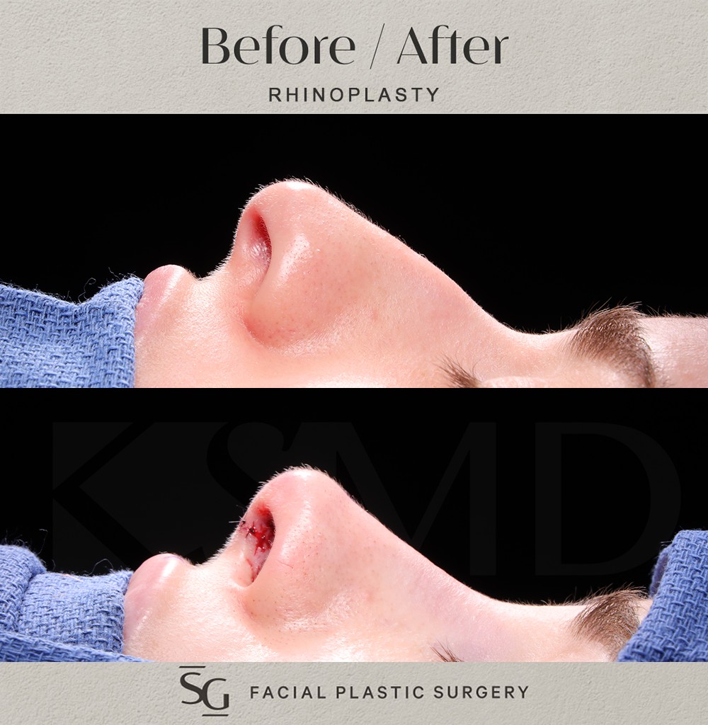 JP-profile-2-intraop
