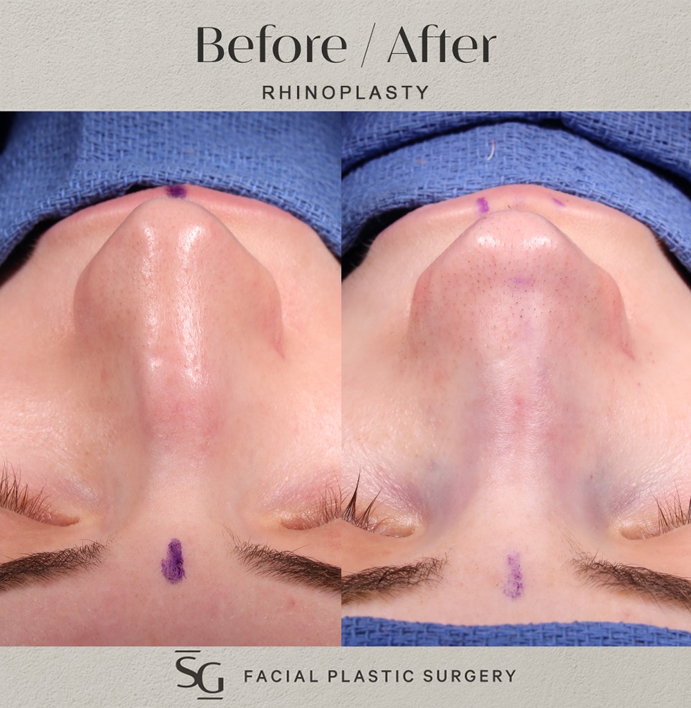 JP-frontal-intraop