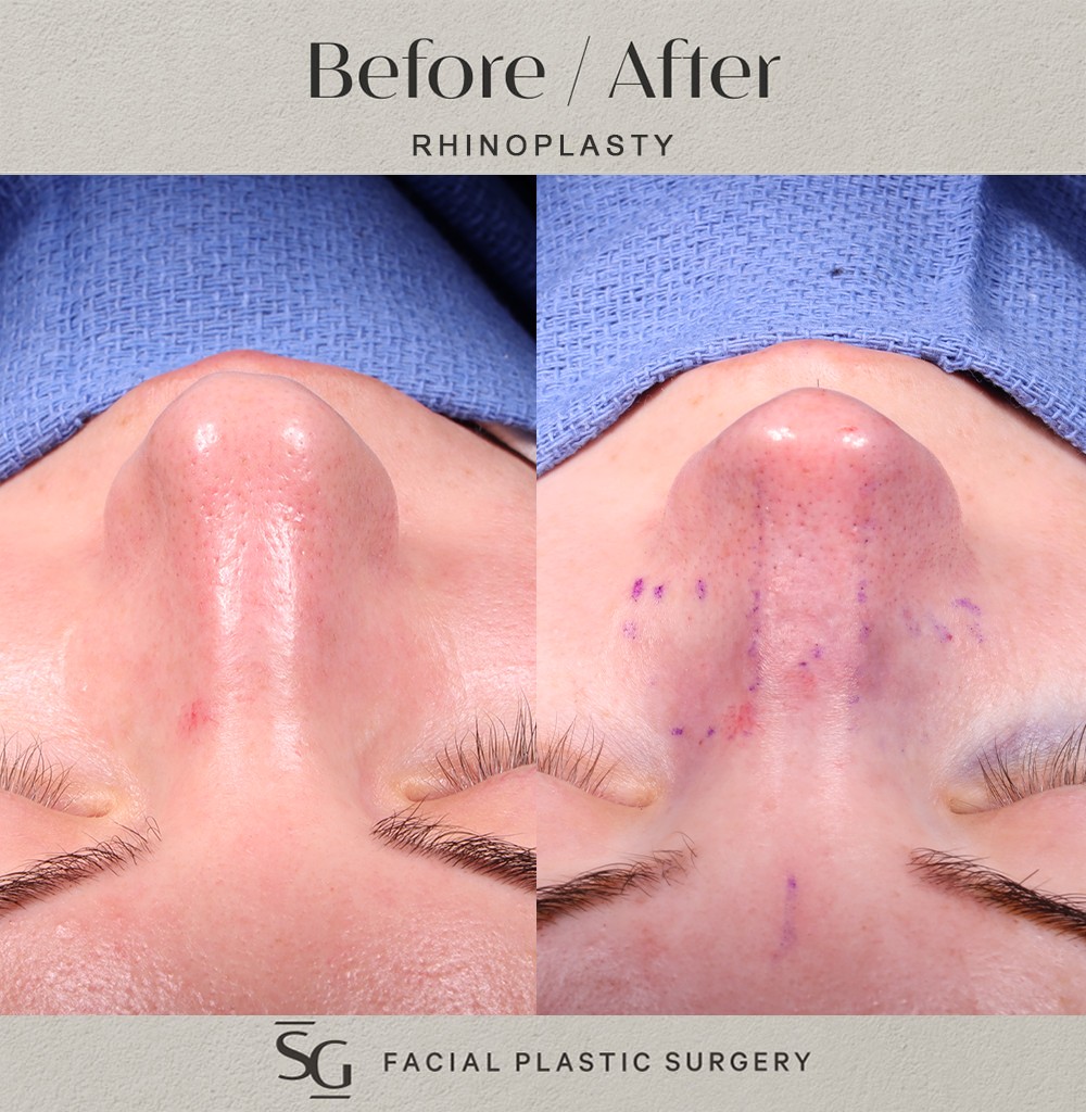 JD-intraop-frontal
