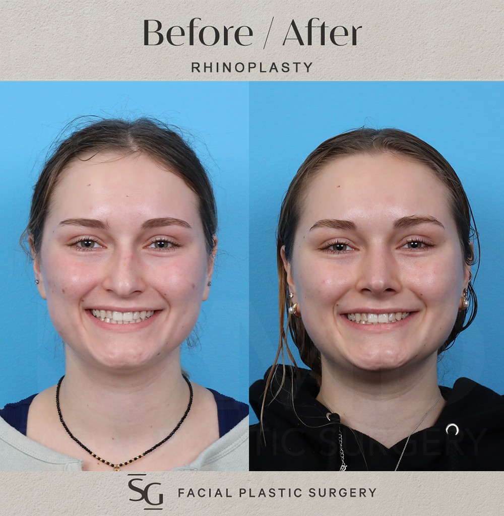 PK frontal smile