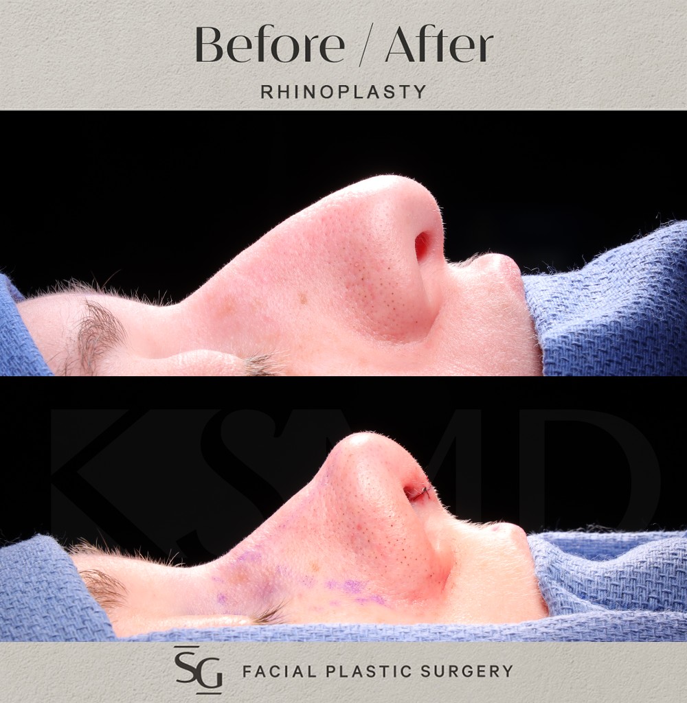 ND-profile-1-intraop