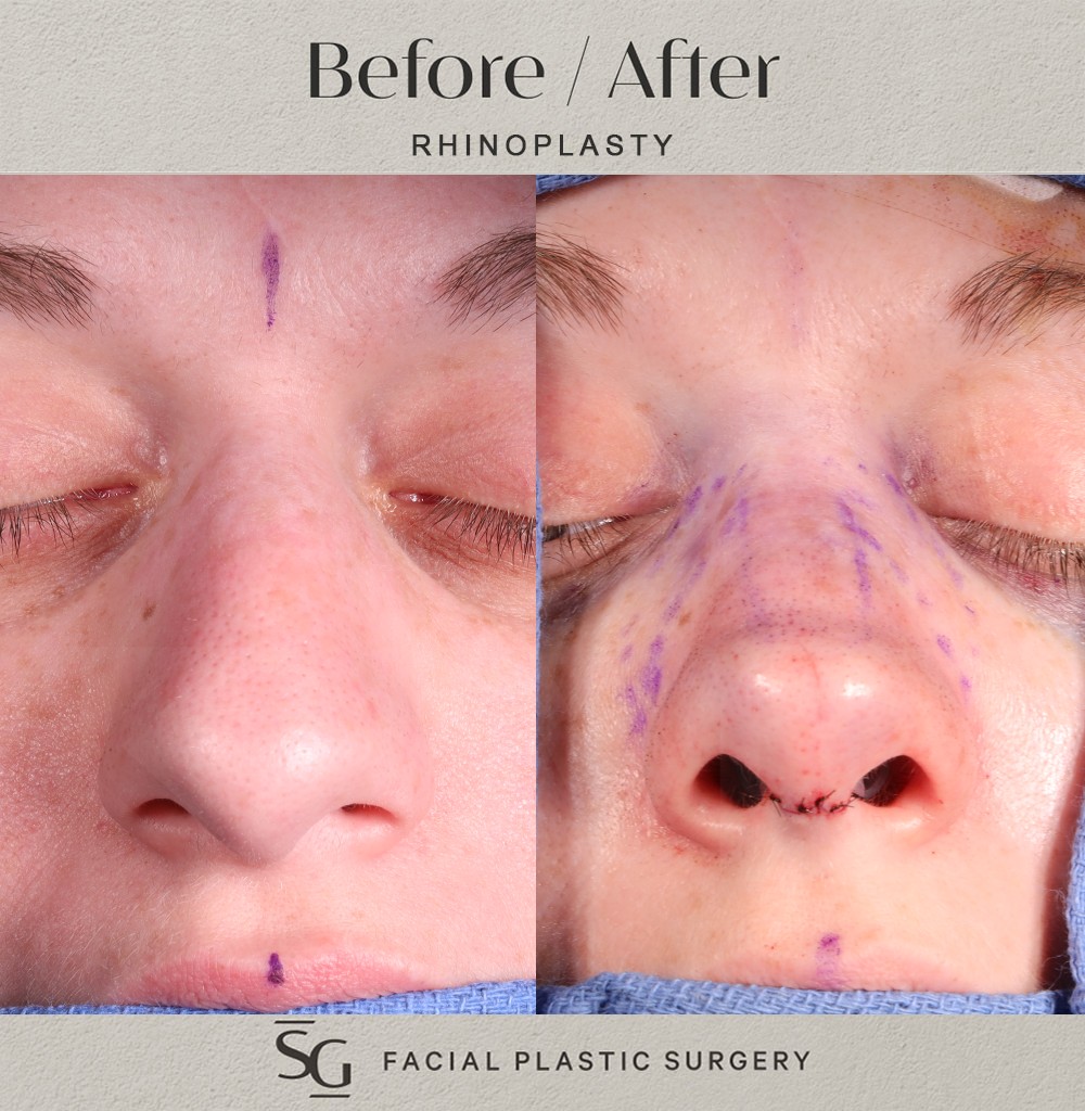 ND-frontal-2-intraop