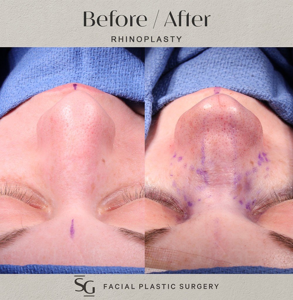 ND-frontal-intraop