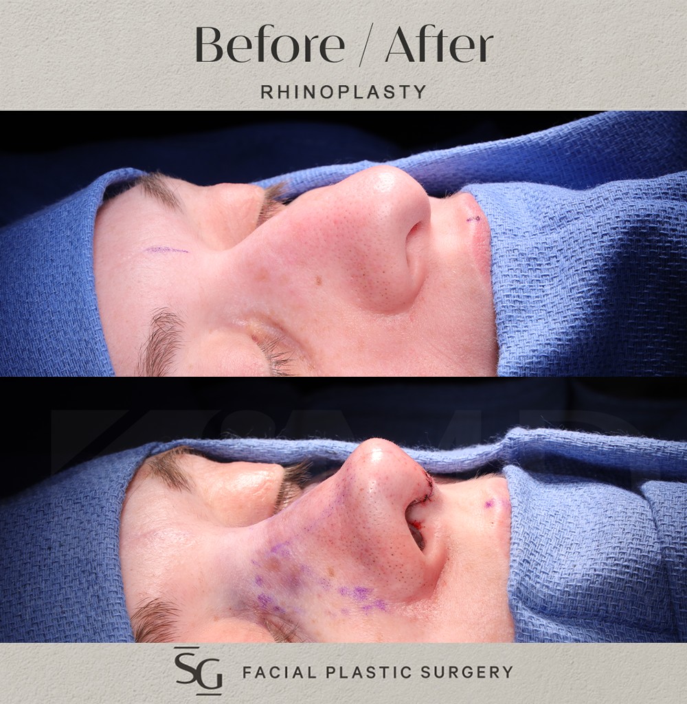ND-oblique-1-intraop