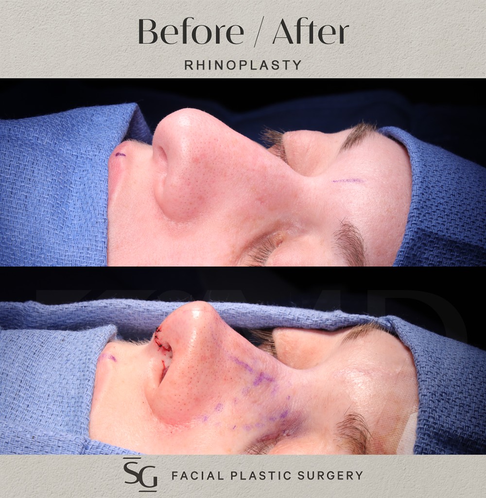 ND-oblique-2-intraop