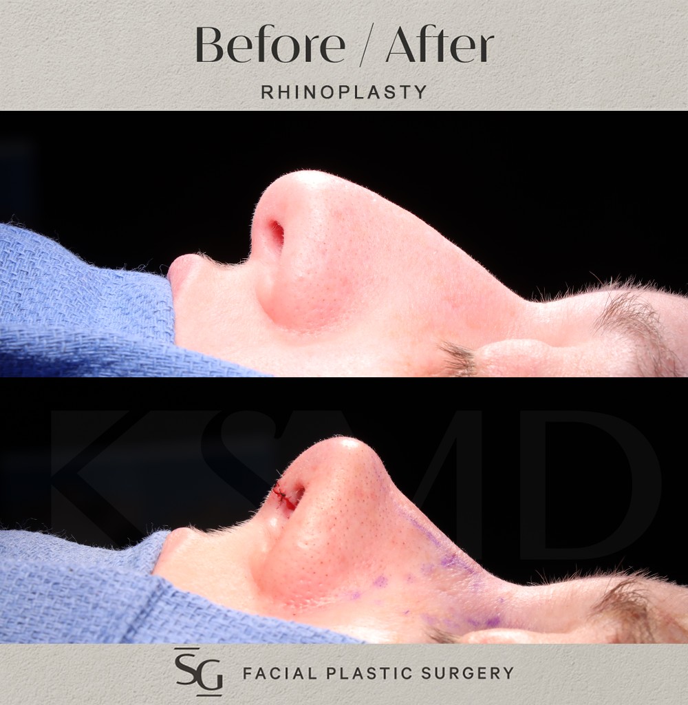 ND-profile-2-intraop