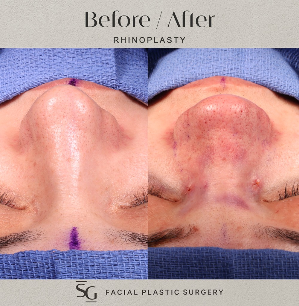 MG-frontal-intraop