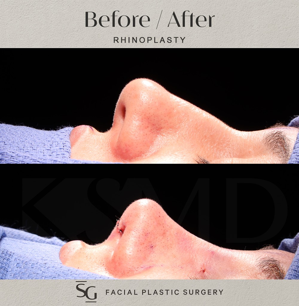 MG-profile-2-intraop