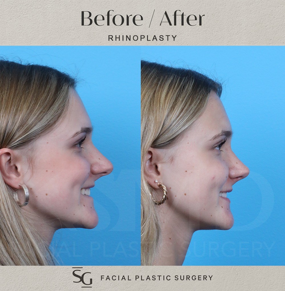 OZ-6-wk-profile-2-smile