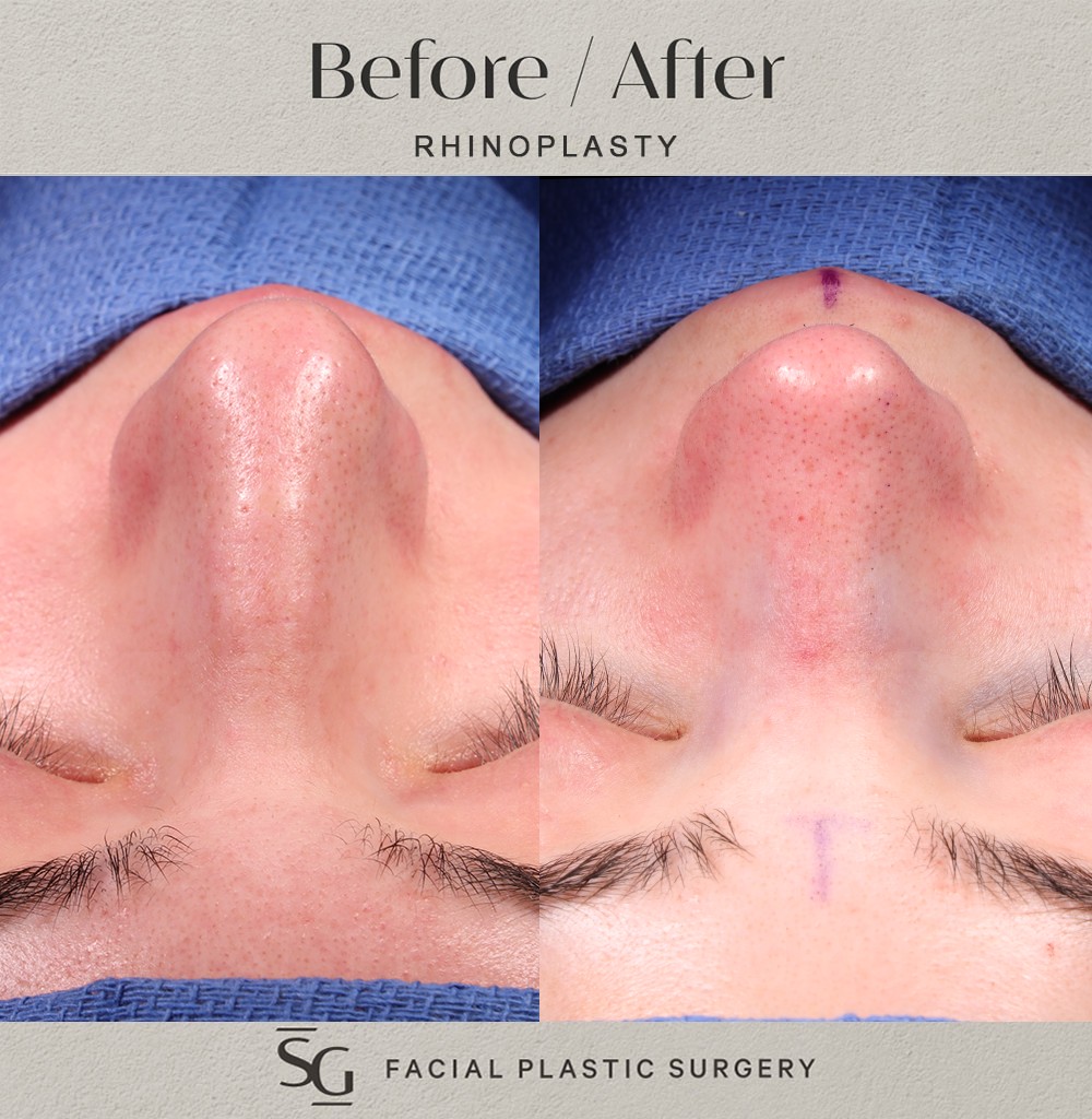 KD-frontal-intraop