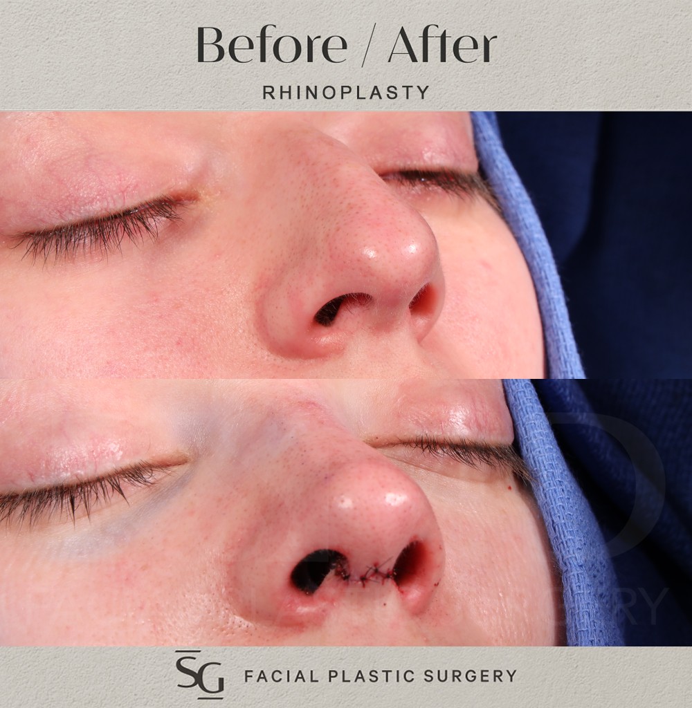KD-oblique-1-intraop
