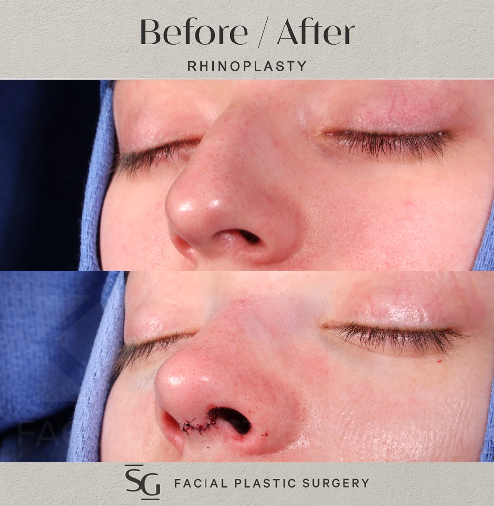 KD-oblique-2-intraop