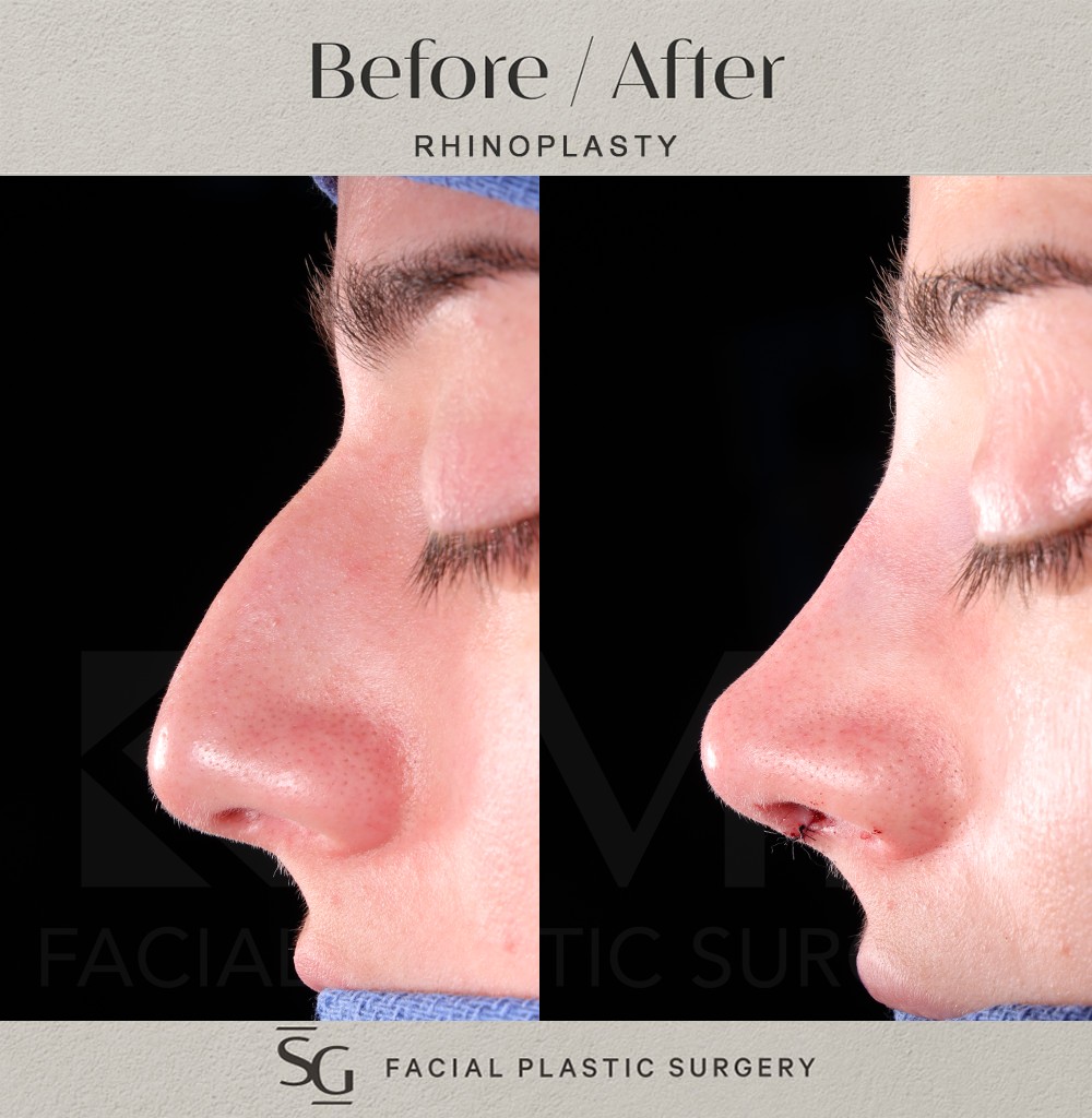 KD-profile-2-intraop