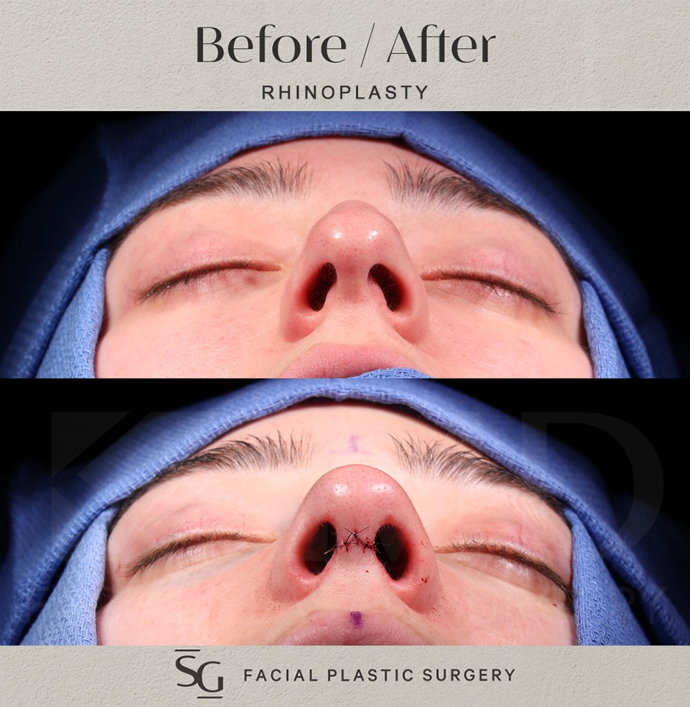 KS-basal-intraop