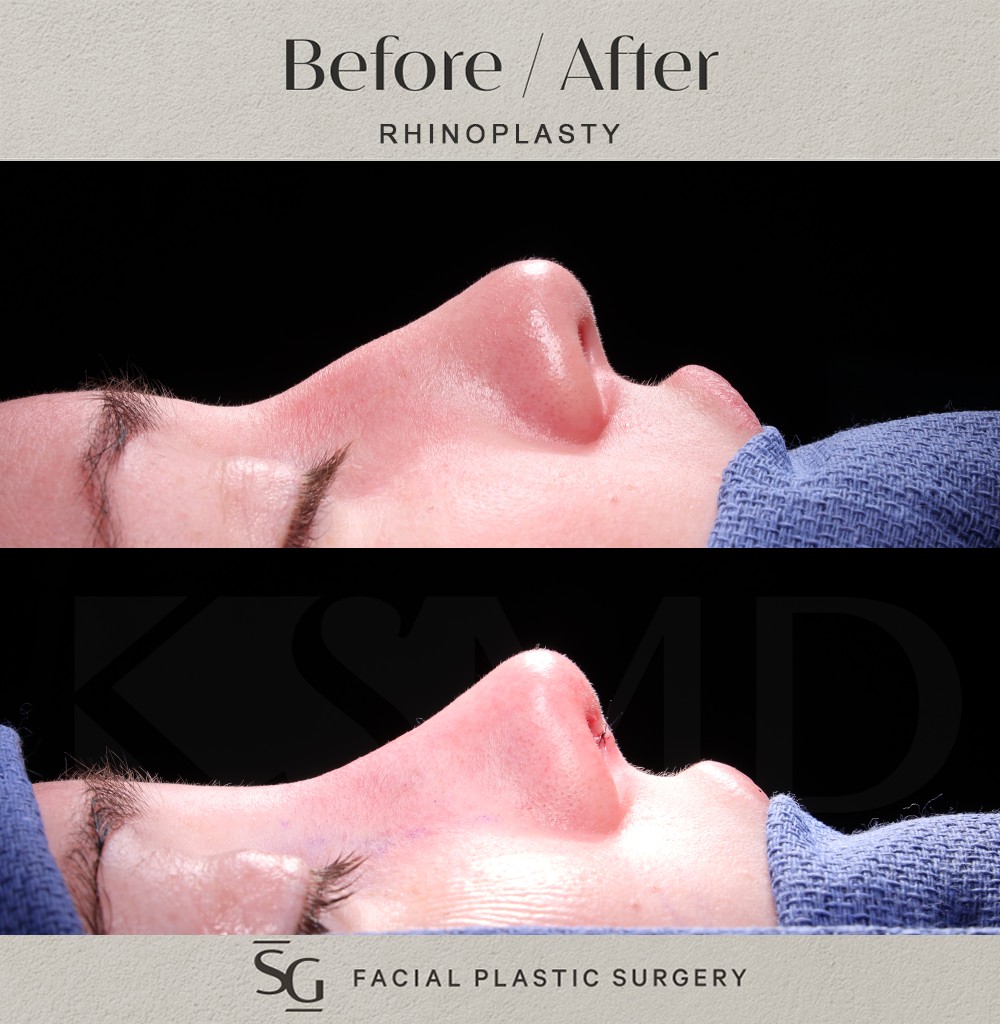 SL-profile-1-intraop