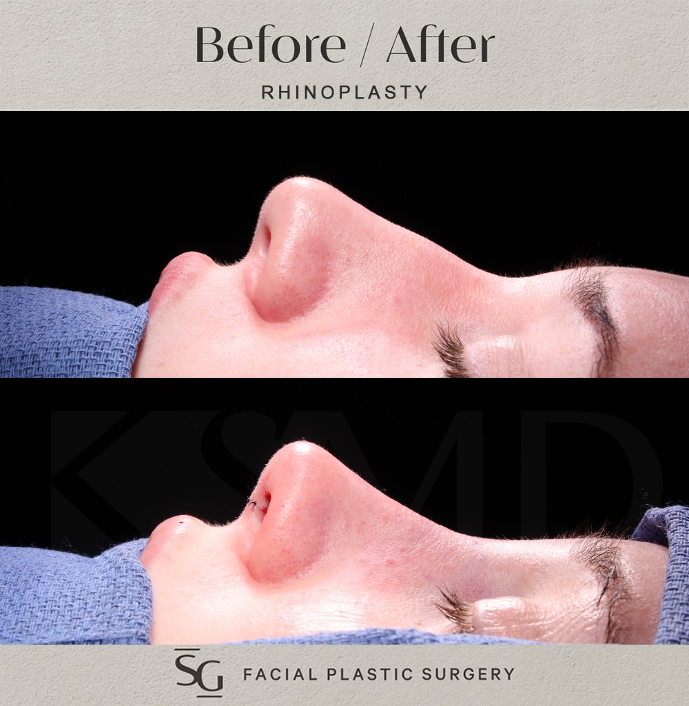 SL-profile-2-intraop