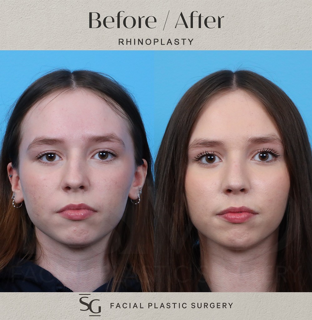 ZA frontal 3 month