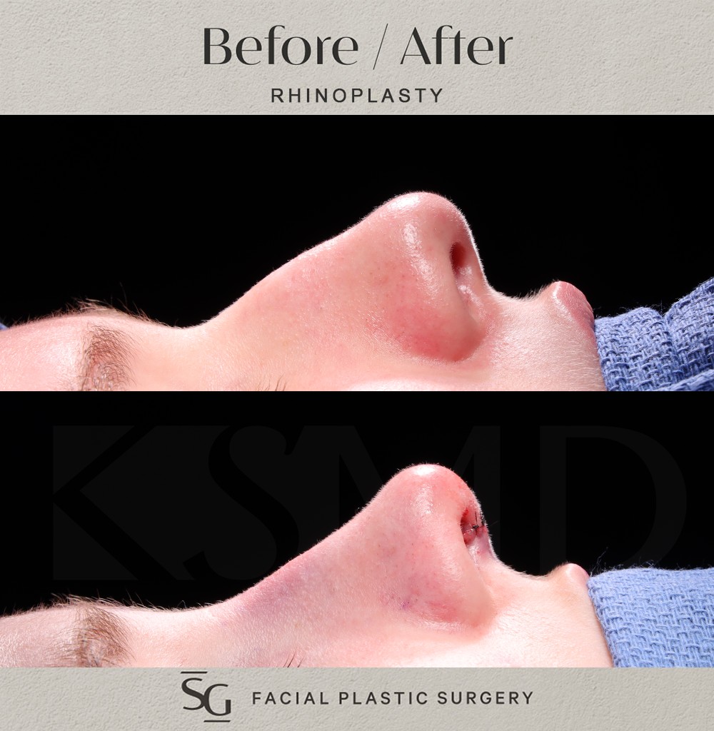 ZA profile 1 intraop