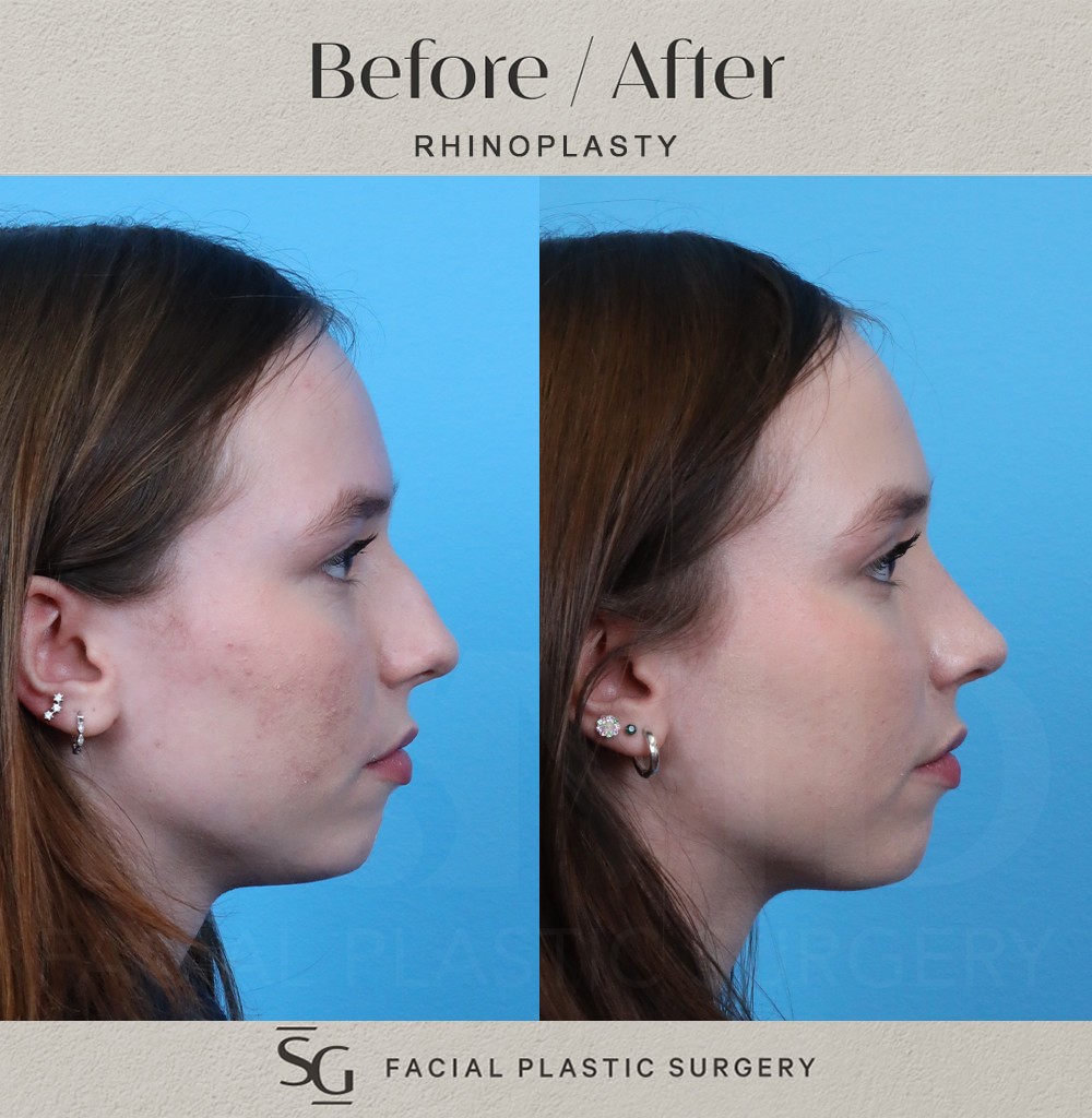 ZA profile 2 3 month