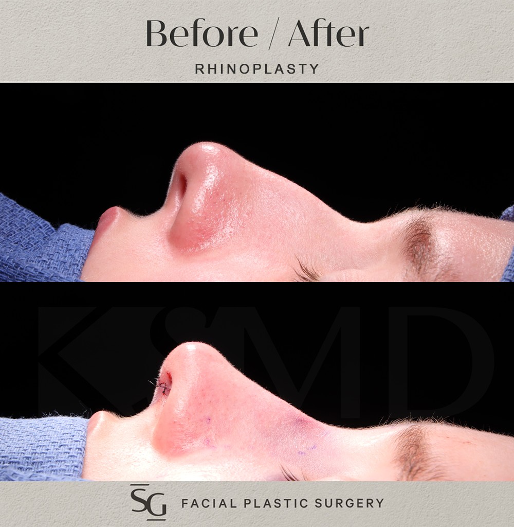 ZA profile 2 intraop
