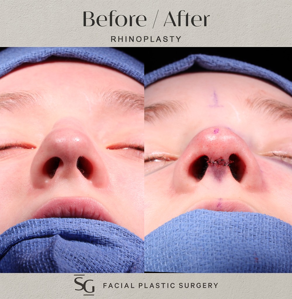 ZA basal intraop