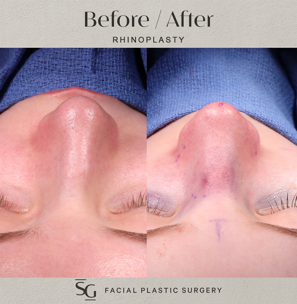 ZA frontal intraop