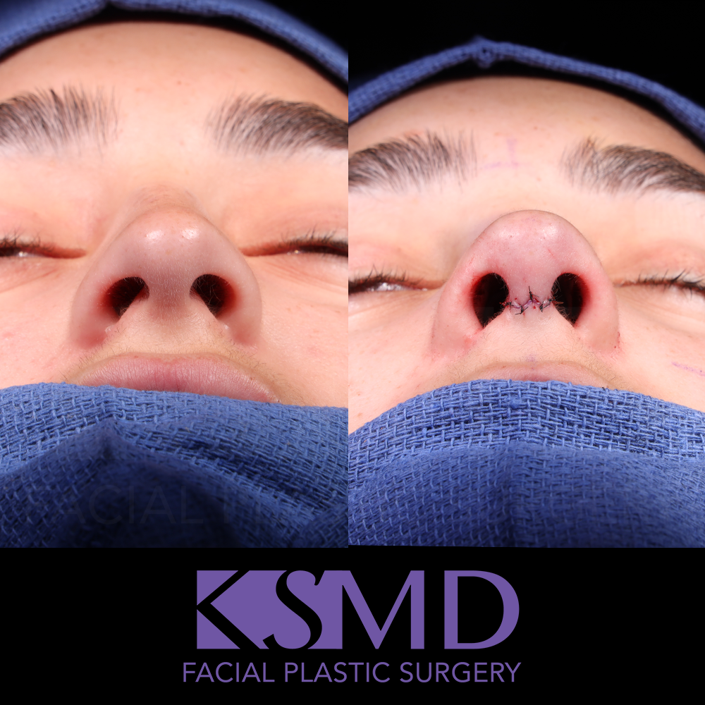 AG basal intraop
